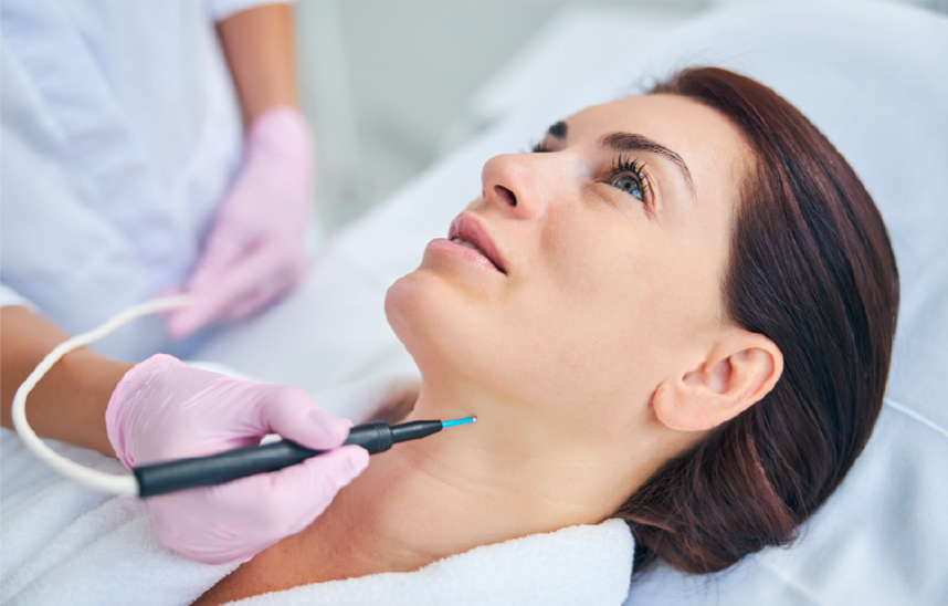 CO²レーザー(炭酸ガスレーザー)とは？