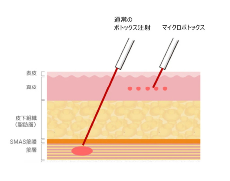 マイクロボツリヌス注射の効果