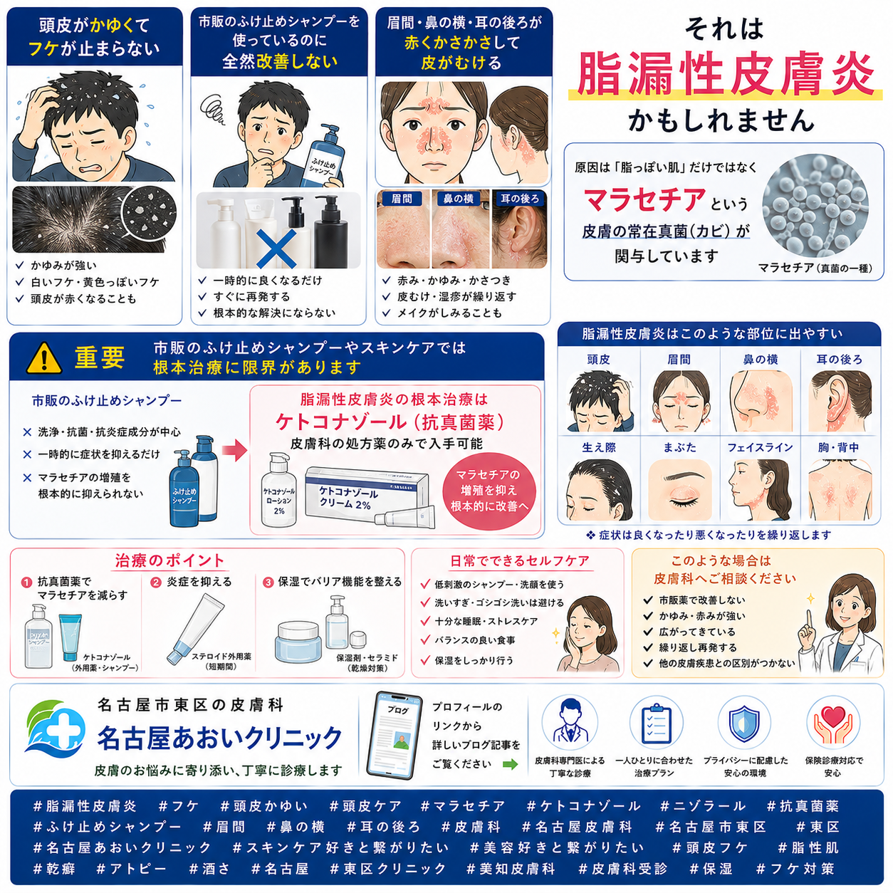 脂漏性皮膚炎——頭皮のフケ・かゆみ・顔の赤みの原因（マラセチア）と正しい治療（ケトコナゾール）を名古屋あおいクリニック（名古屋市東区・皮膚科）が詳しく解説